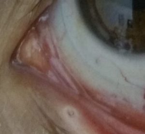 טיפול של עדשות סקלרליות בעין יבשה דר' ניר ארדינסט. בתמונה עדשת מגע סקלרלית לטיפול ביובש בקוטר 17 ממ' יחד עם פלאג בפונקטה התחתונה.